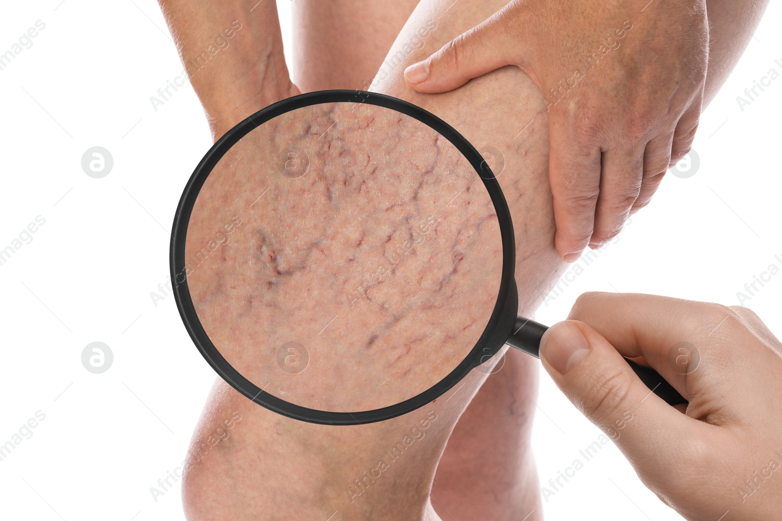 Image of Woman suffering from varicose veins on white background, closeup. Affected leg, zoomed view through magnifying glass