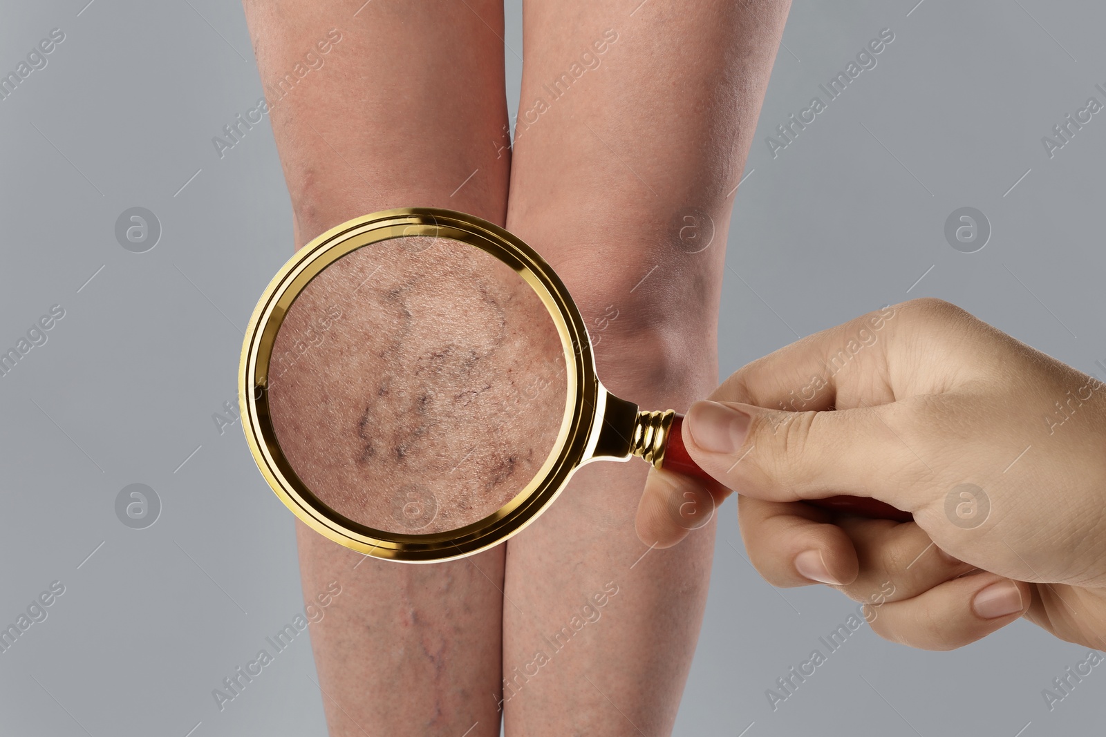 Image of Woman suffering from varicose veins on grey background, closeup. Affected leg, zoomed view through magnifying glass