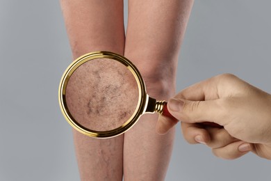 Woman suffering from varicose veins on grey background, closeup. Affected leg, zoomed view through magnifying glass