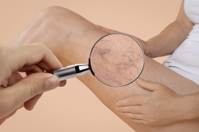 Woman suffering from varicose veins on dark beige background, closeup. Affected leg, zoomed view through magnifying glass