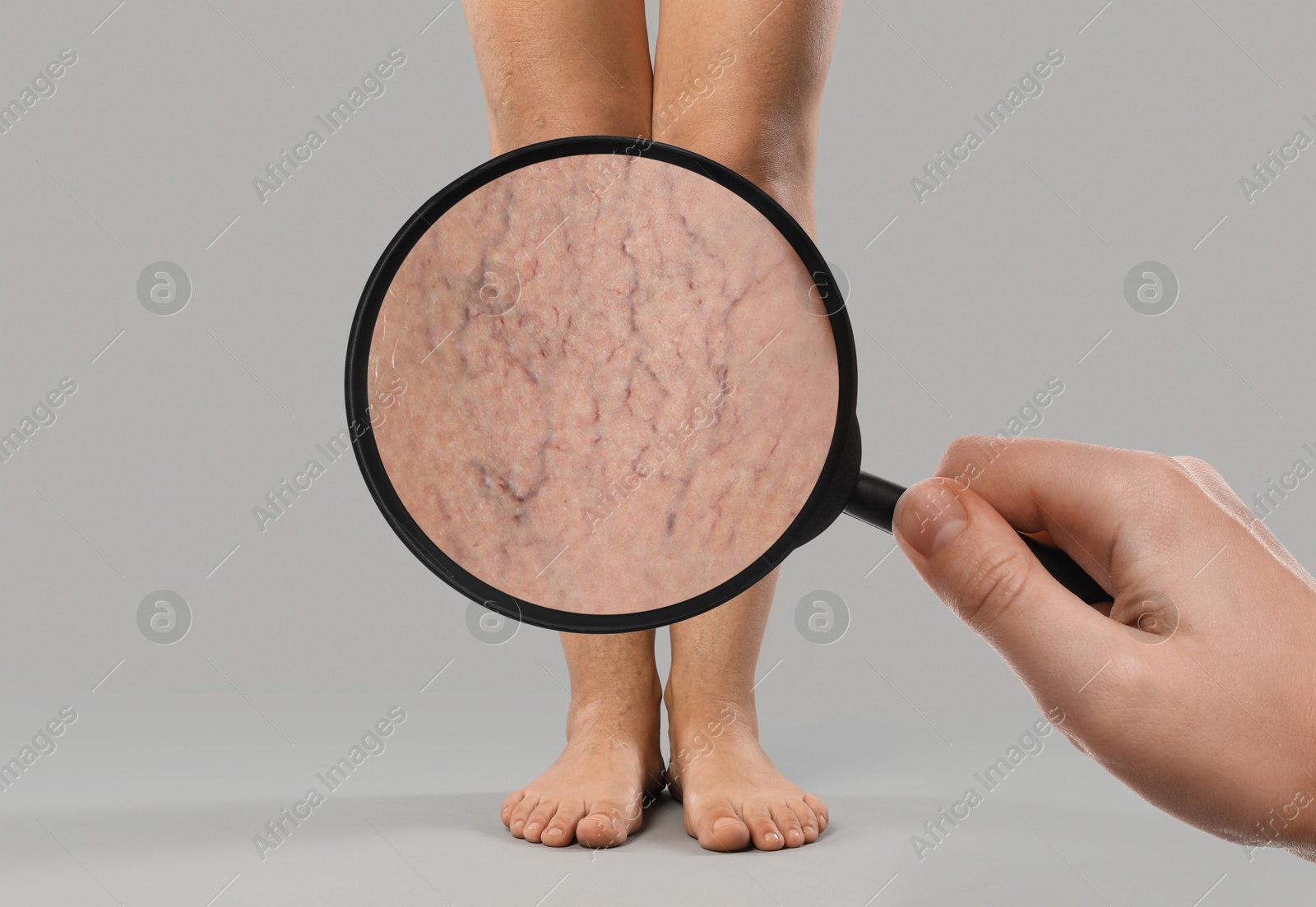 Image of Woman suffering from varicose veins on light grey background, closeup. Affected leg, zoomed view through magnifying glass