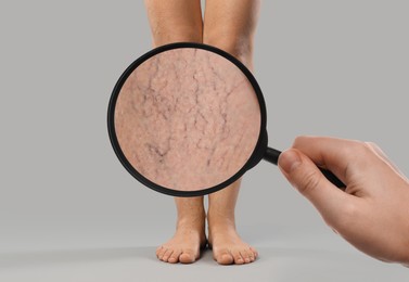 Image of Woman suffering from varicose veins on light grey background, closeup. Affected leg, zoomed view through magnifying glass