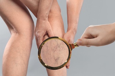 Woman suffering from varicose veins on light grey background, closeup. Affected leg, zoomed view through magnifying glass