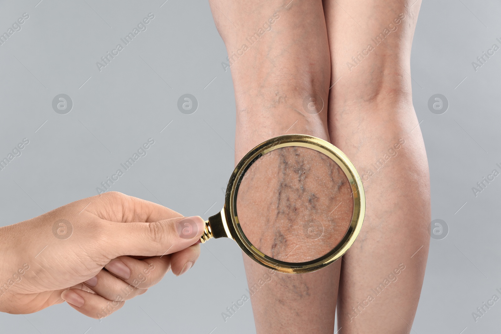 Image of Woman suffering from varicose veins on light grey background, closeup. Affected leg, zoomed view through magnifying glass