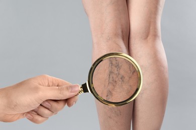 Woman suffering from varicose veins on light grey background, closeup. Affected leg, zoomed view through magnifying glass