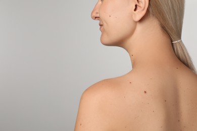 Photo of Closeup of woman`s body with birthmarks on light grey background, back view. Space for text