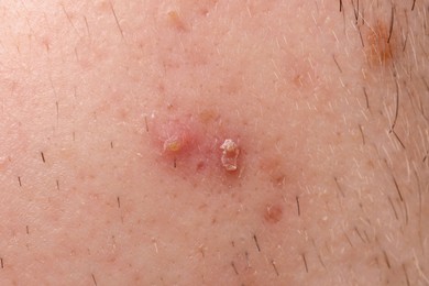 Photo of Young man with acne problem, closeup view of cheek