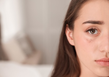 Photo of Young woman with eyelash loss problem indoors