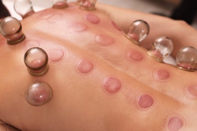 Photo of Cupping therapy. Closeup view of man with glass cups on his back indoors