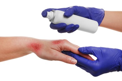 Photo of Doctor applying panthenol onto patient's burns on white background, closeup