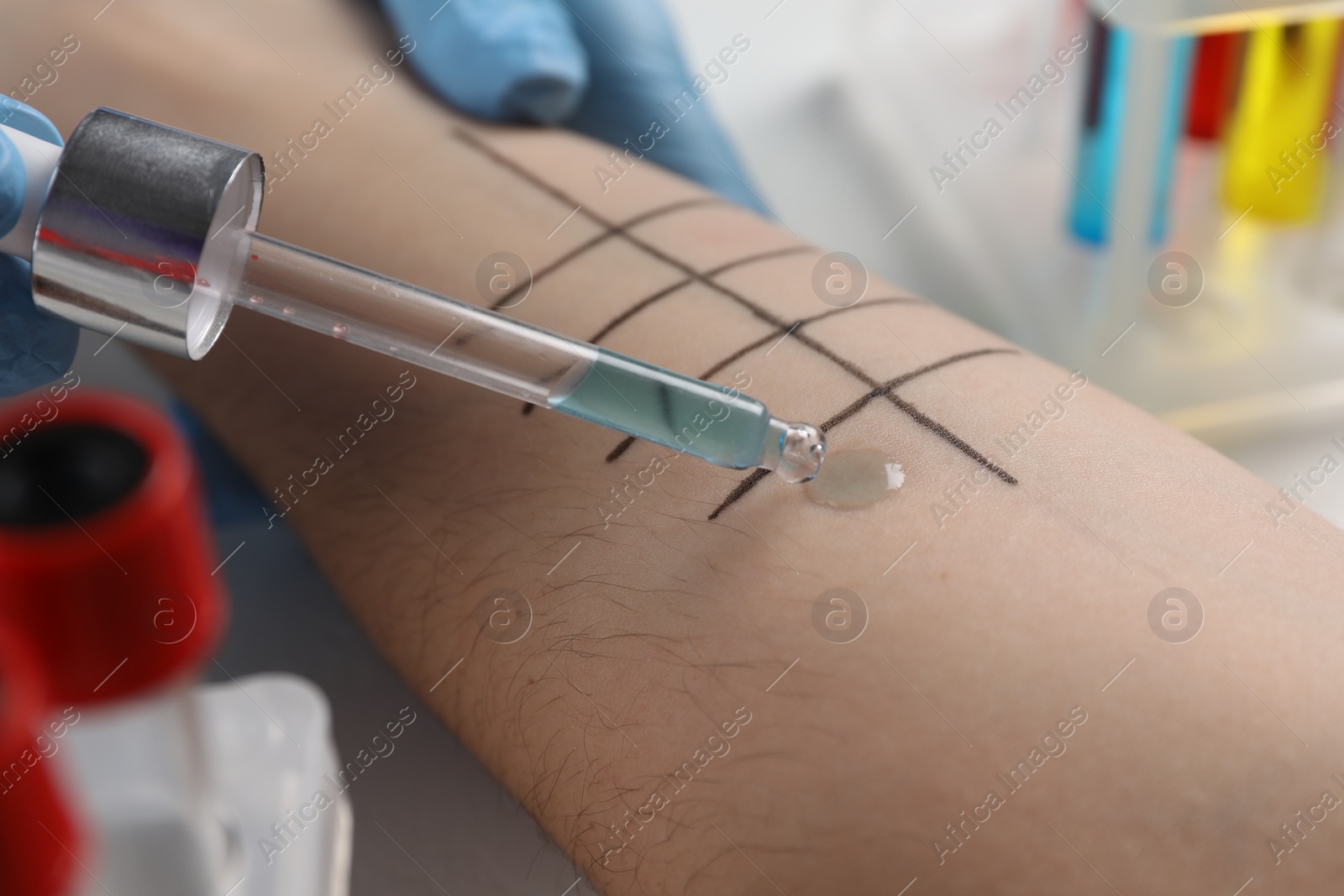 Photo of Patient undergoing skin allergy test at light table in clinic, closeup