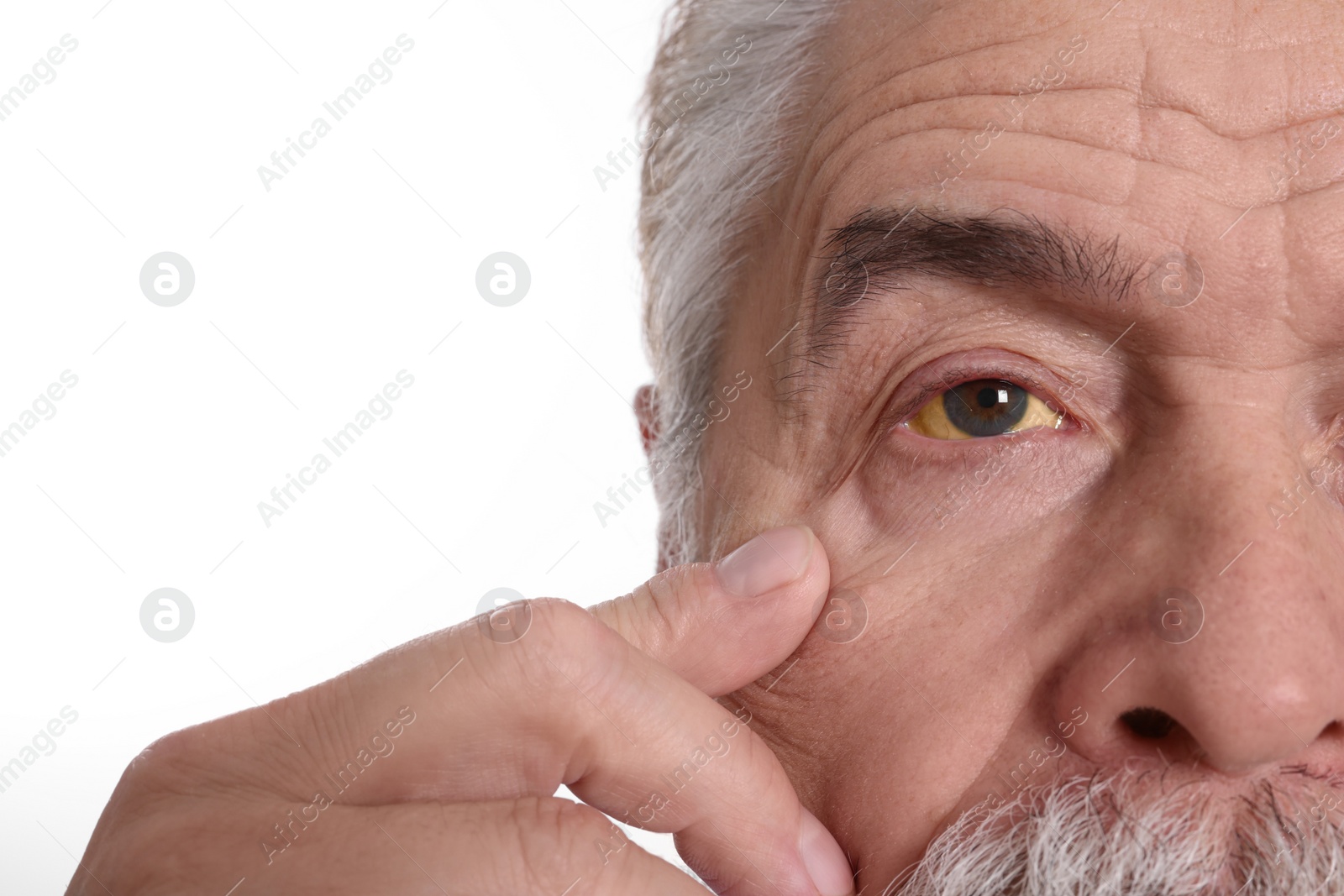 Photo of Senior man with yellow eyes on white background, closeup. Symptom of hepatitis