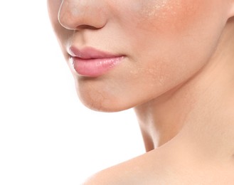 Young woman with dry skin on white background, closeup