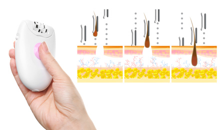 Image of Epilation procedure. Woman holding modern appliance near illustrations of hair follicle removing on white background, closeup
