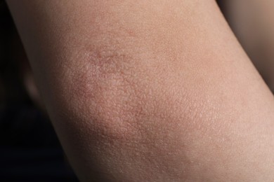 Photo of Woman with dry skin on elbow, closeup