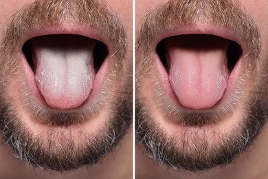 Man showing his tongue before and after cleaning procedure, closeup. Tongue coated with plaque on one side and healthy on other, collage