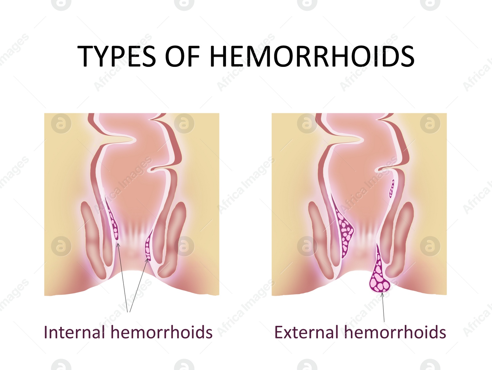 Image of Hemorrhoid types. Unhealthy lower rectum with inflamed vascular structures, illustration