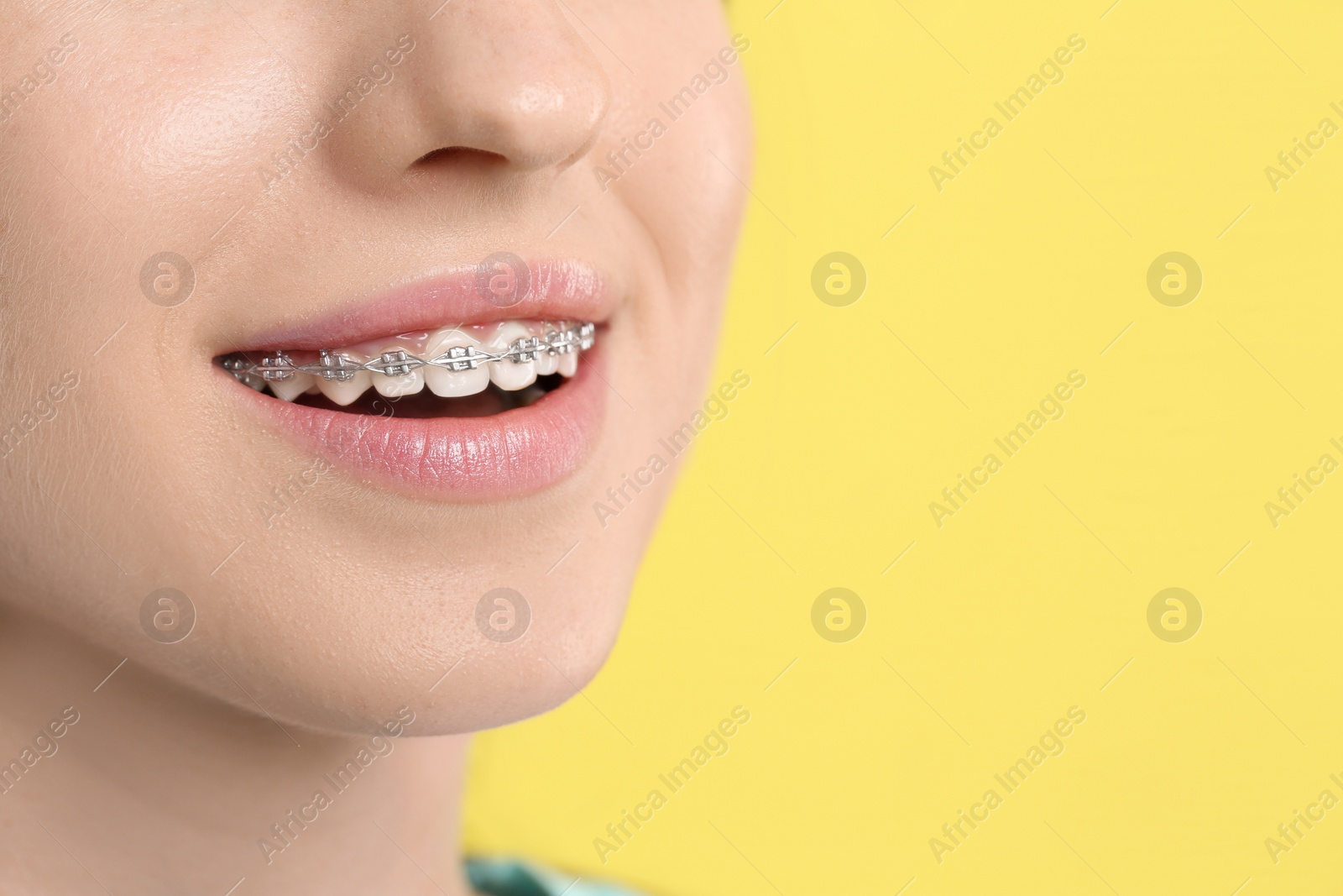 Photo of Smiling woman with dental braces on yellow background, closeup. Space for text