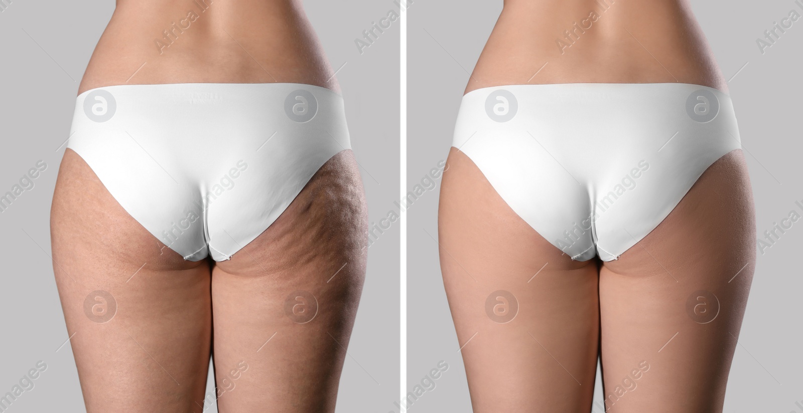 Image of Collage with photos of woman before and after anti cellulite treatment on grey background, 