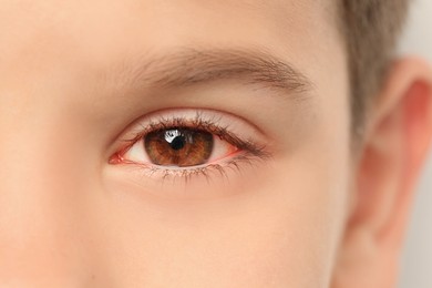 Image of Little child suffering from conjunctivitis, closeup view