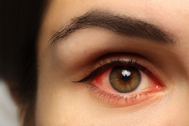 Closeup view of woman with inflamed eyes