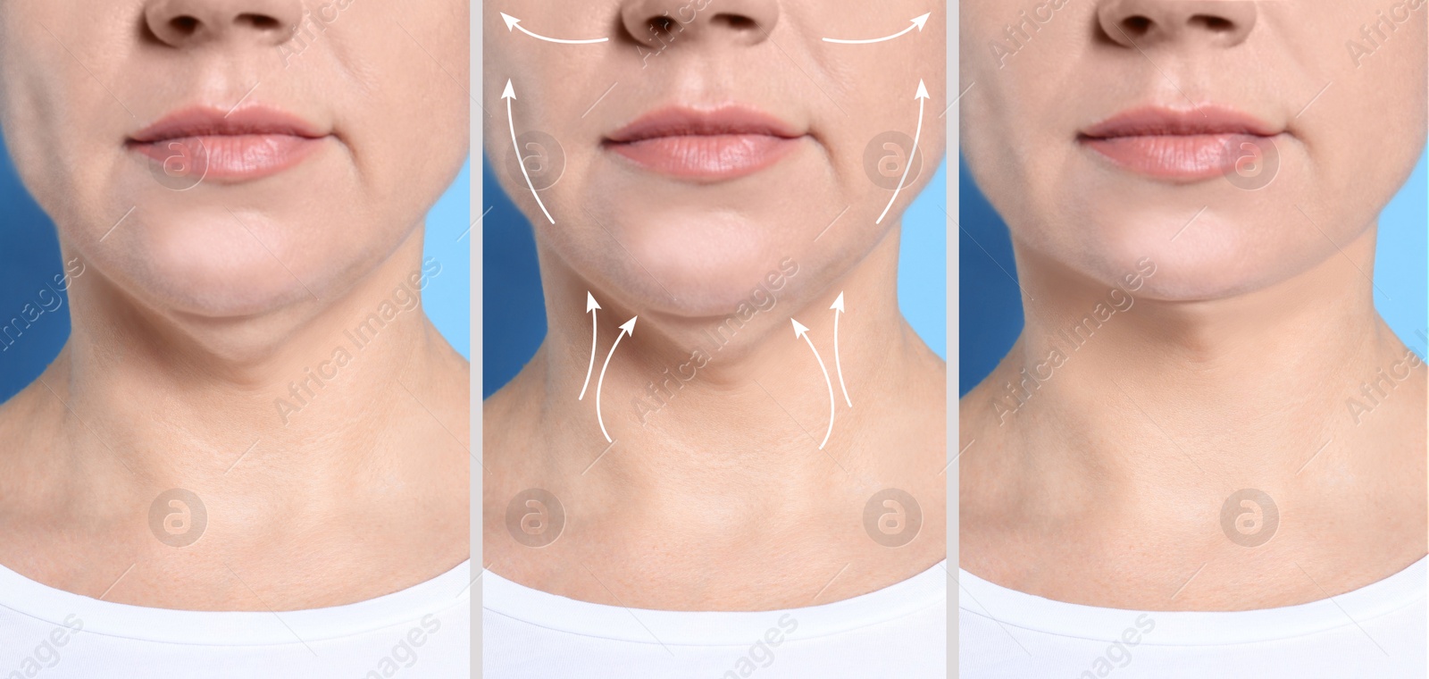 Image of Mature woman before and after plastic surgery operation on blue background, closeup. Double chin problem 