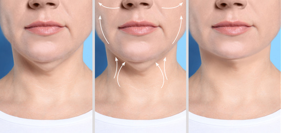 Image of Mature woman before and after plastic surgery operation on blue background, closeup. Double chin problem 
