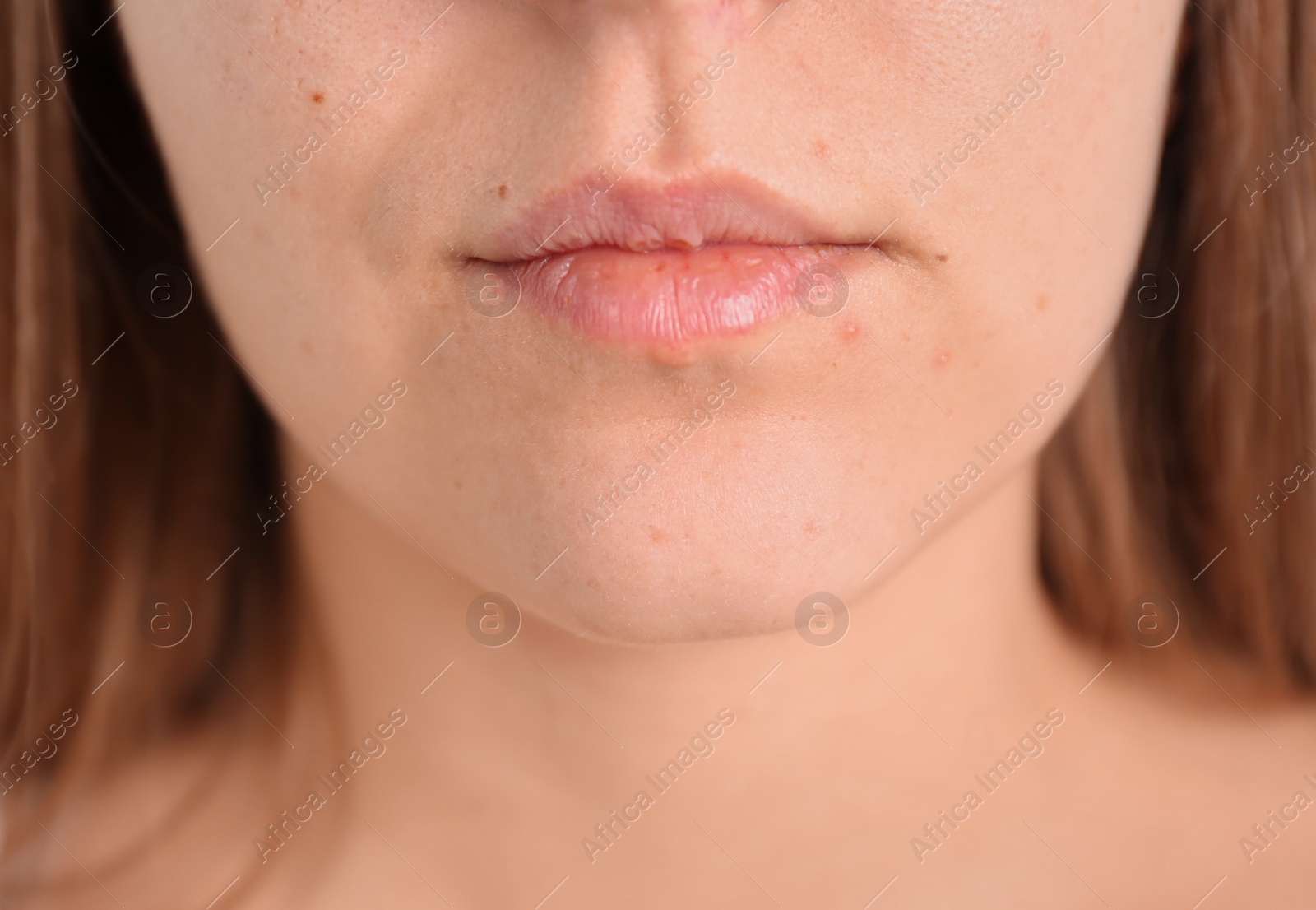 Photo of Young woman with acne problem, closeup