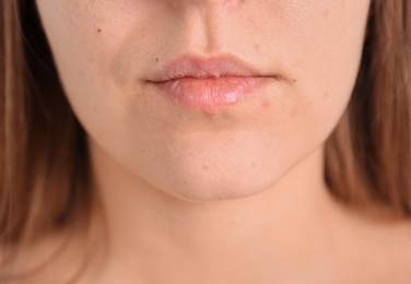 Photo of Young woman with acne problem, closeup