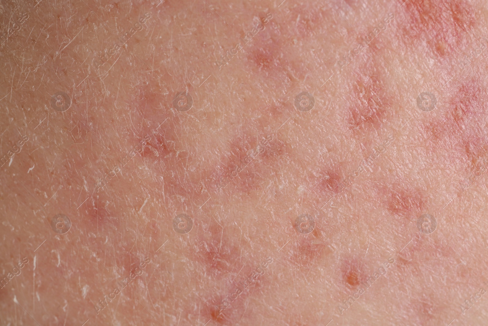 Photo of Texture of skin with acne problem as background, macro view