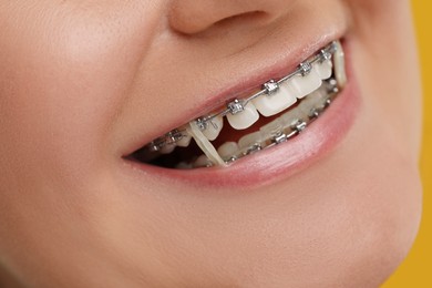Smiling woman with dental braces and orthodontic elastics, closeup