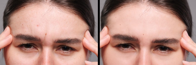 Aging skin changes. Woman showing face before and after rejuvenation, closeup. Collage comparing skin condition