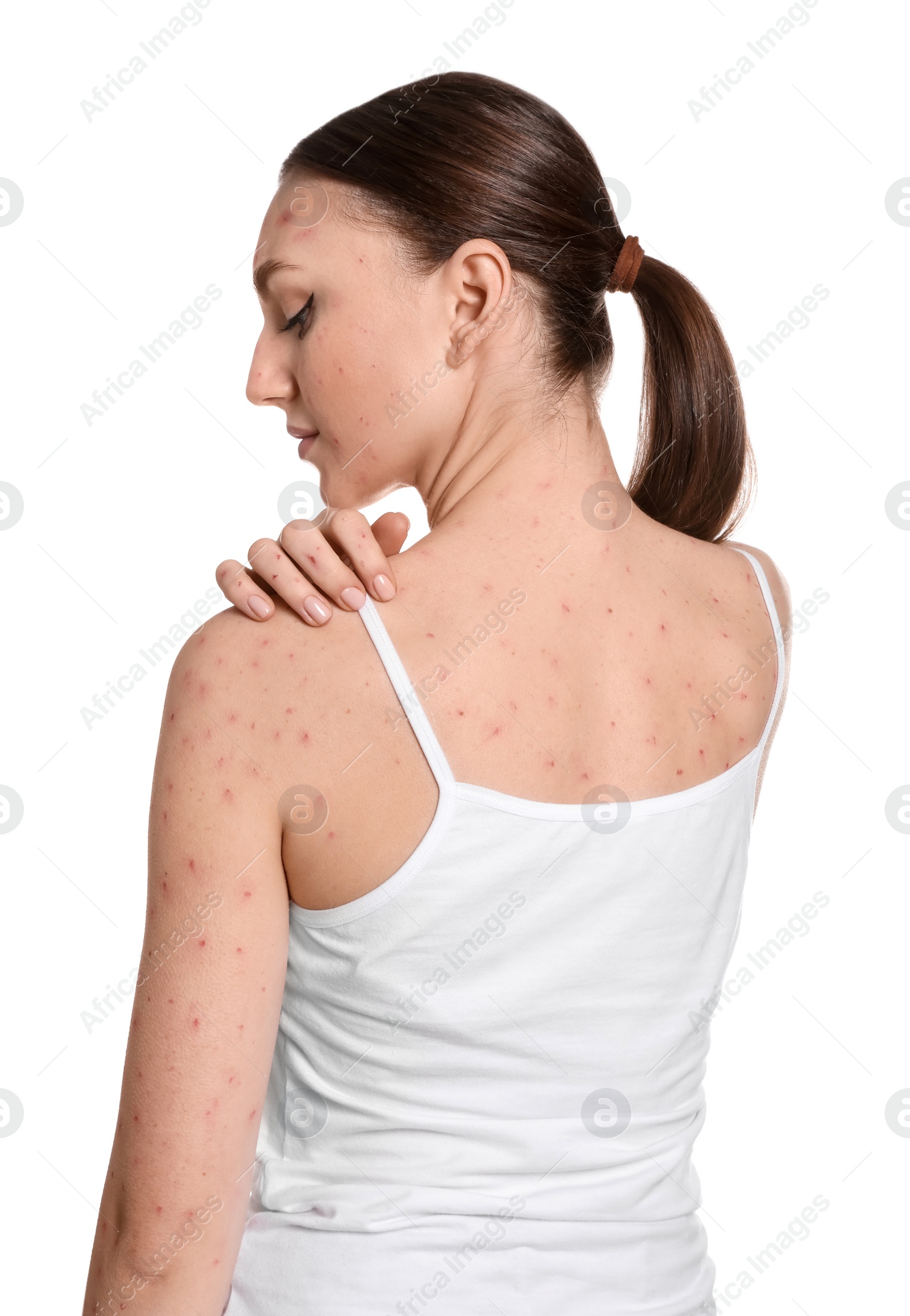 Photo of Woman with rash suffering from monkeypox virus on white background