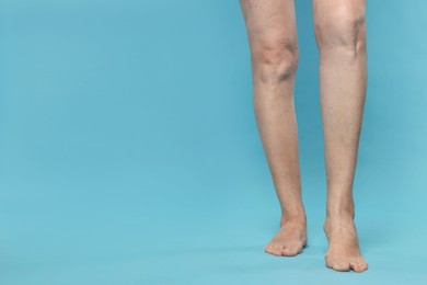 Closeup view of woman with varicose veins on light blue background. Space for text