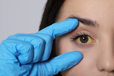 Photo of Doctor checking woman with yellow eyes on light background, closeup. Symptom of hepatitis