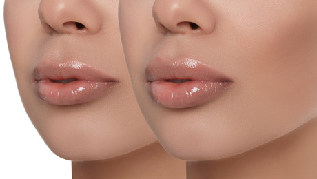 Image of Woman before and after lip correction procedure, closeup