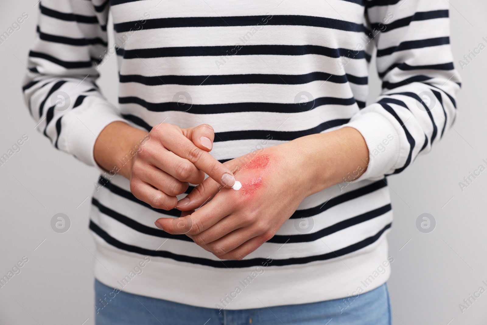 Photo of Woman applying healing cream onto burned hand on light grey background, closeup