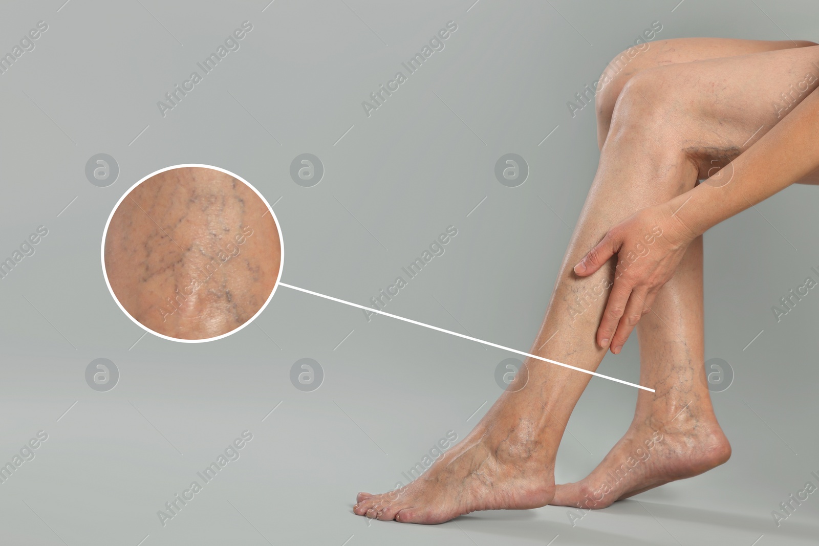 Image of Woman suffering from varicose veins on light grey background, closeup. Magnified skin surface showing affected area