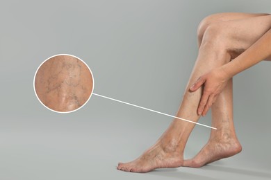 Image of Woman suffering from varicose veins on light grey background, closeup. Magnified skin surface showing affected area
