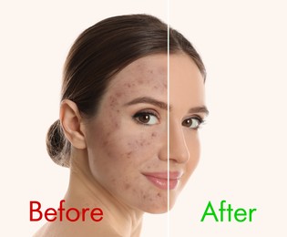 Young woman before and after cosmetic procedure on light background