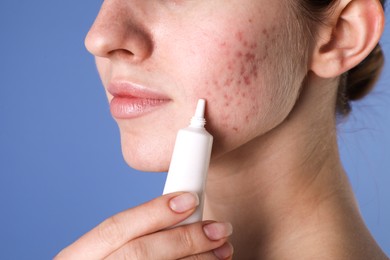 Young woman with acne problem applying cosmetic product onto her skin on blue background, closeup