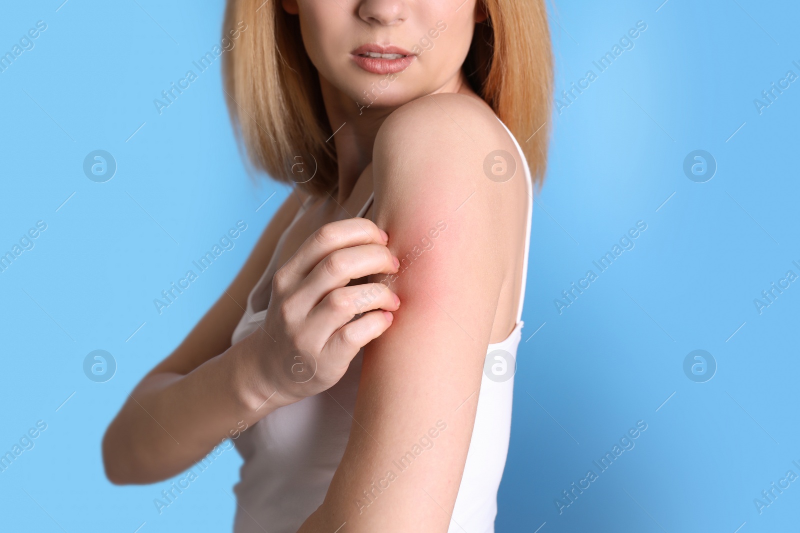 Photo of Woman with allergy symptoms scratching arm on color background, closeup