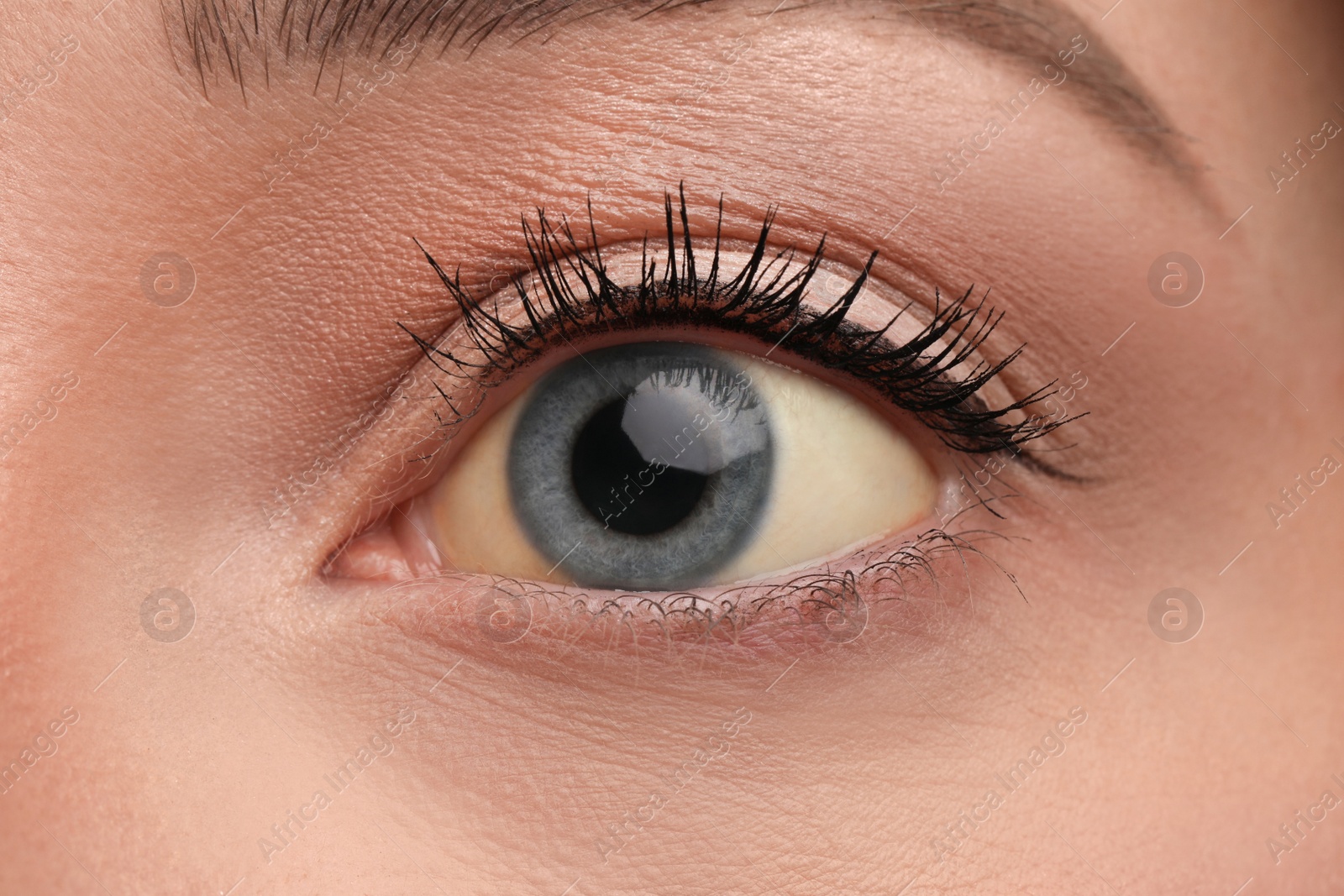 Photo of Woman with yellow eyes as background, closeup. Liver problems symptom