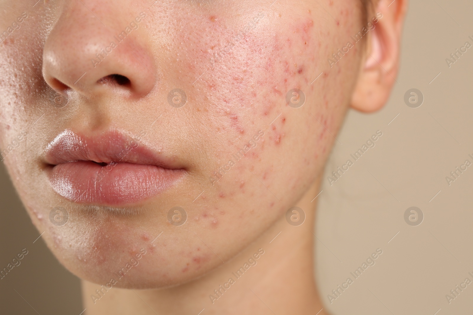 Photo of Teenage girl with acne problem on beige background, closeup