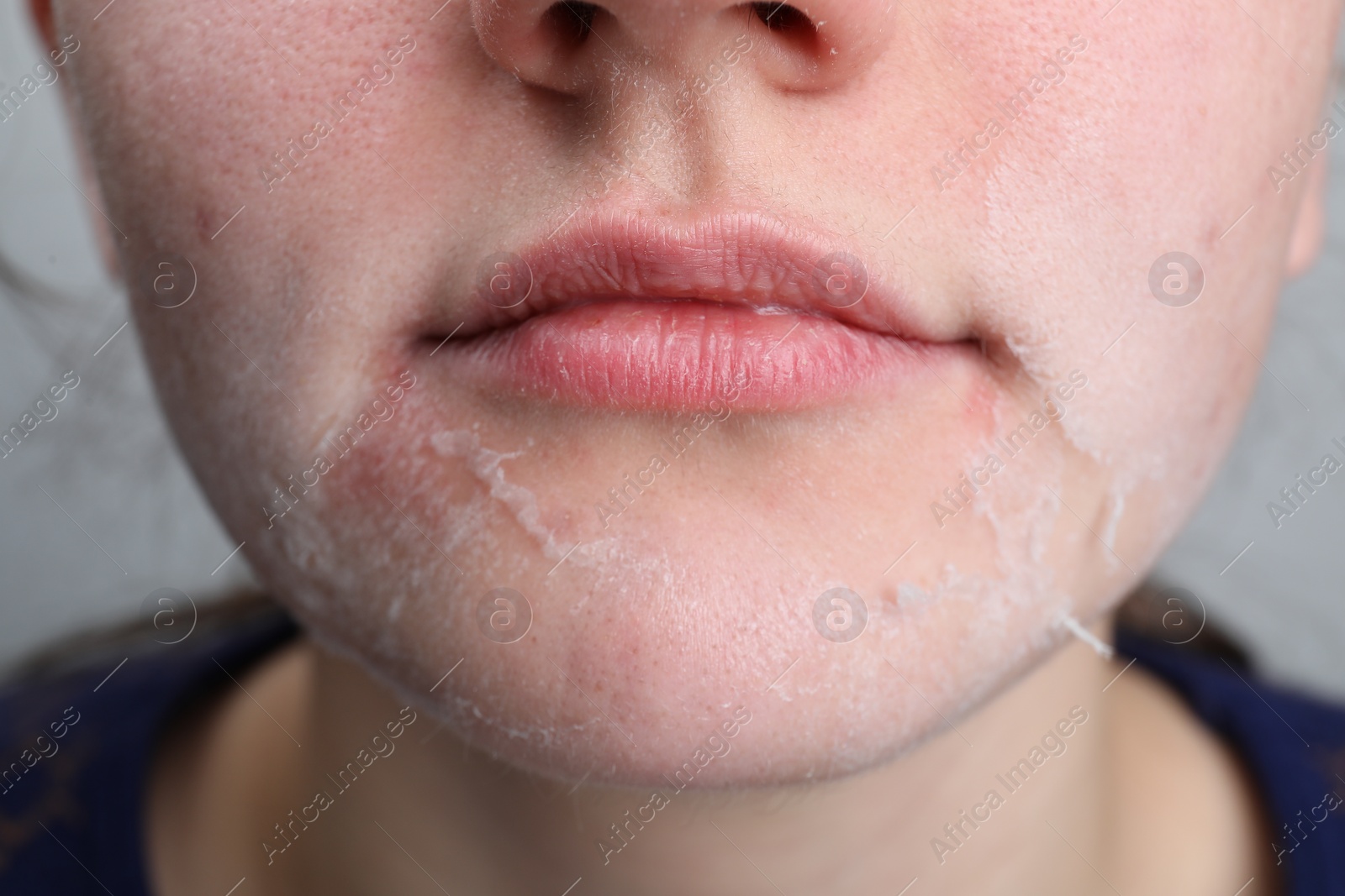 Photo of Woman with dry skin on face, closeup