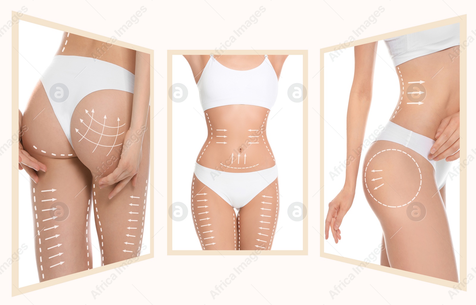 Image of Photos of young woman with marks on body against white background, collage. Cosmetic surgery concept