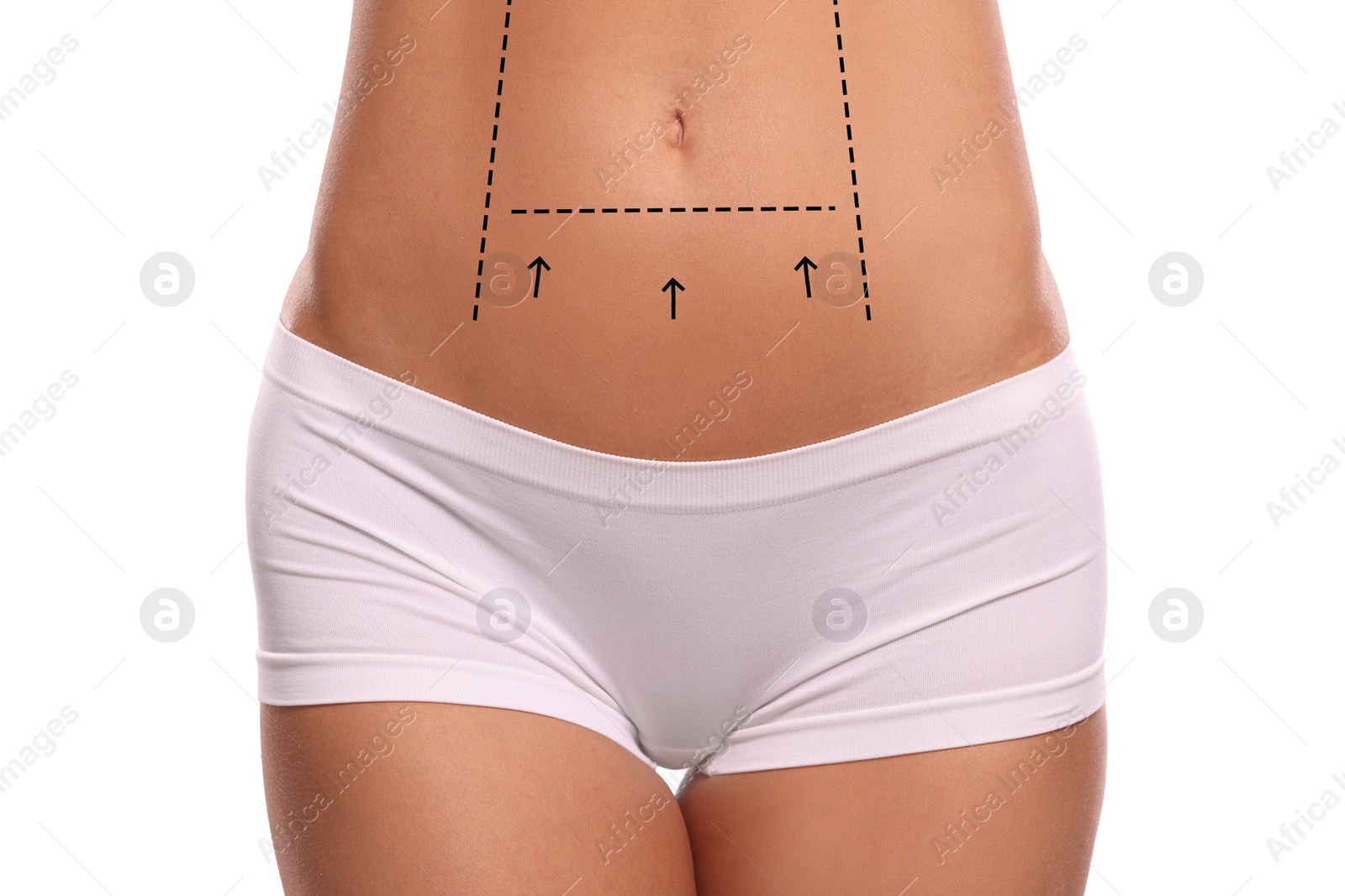 Image of Woman with markings for cosmetic surgery on her abdomen against white background, closeup