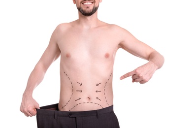 Photo of Young man with marks on belly for cosmetic surgery operation on white background