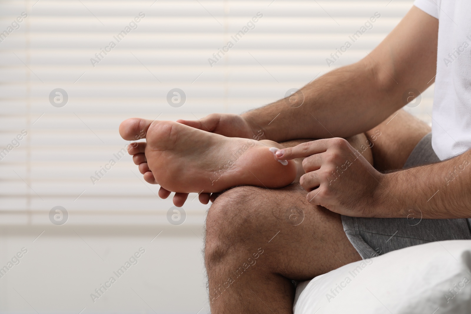 Photo of Man with dry skin applying cream onto his foot on bed, closeup