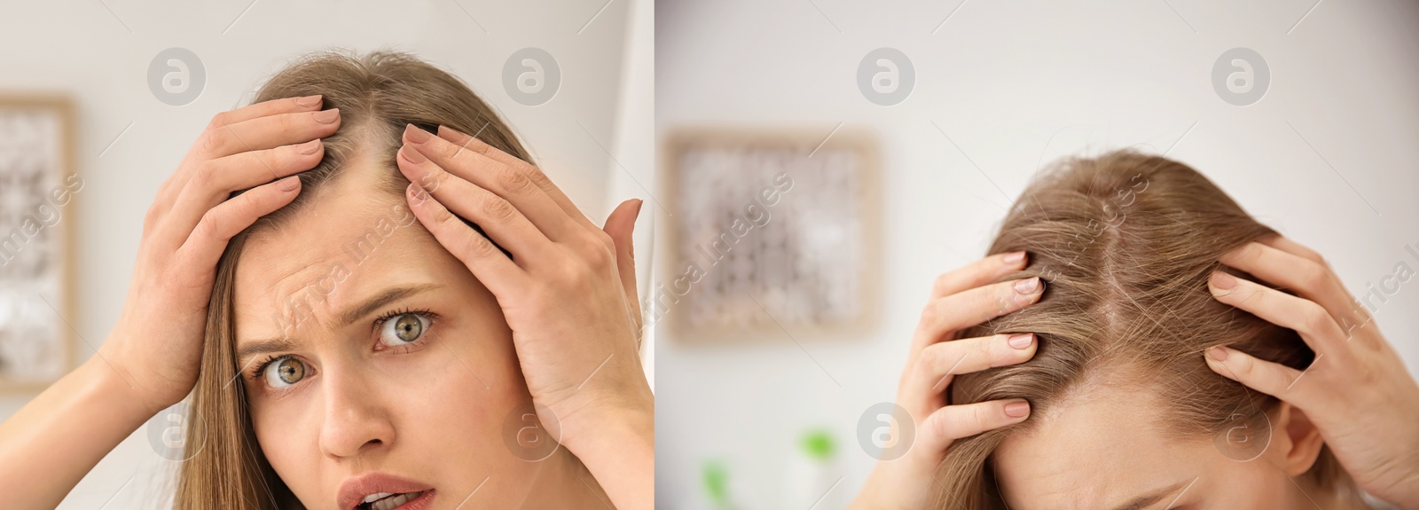 Image of Woman before and after hair treatment with high frequency darsonval device indoors, closeup. Collage of photos